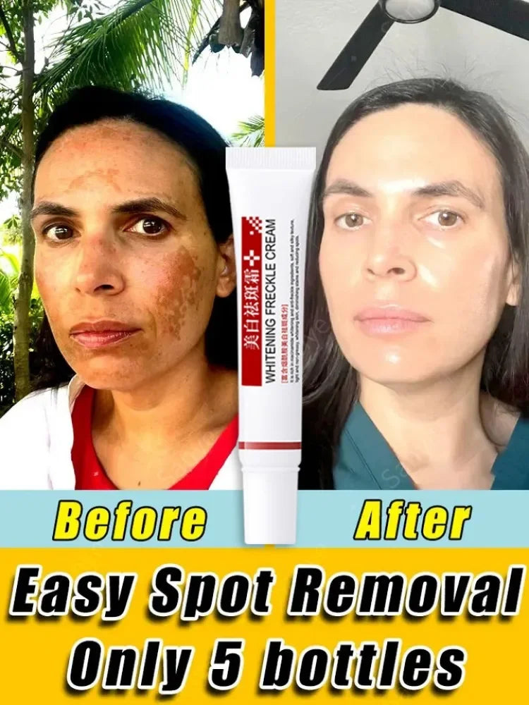 Face Chloasma Removal Cream For Women Remove Melasma Brighten Cream Facial Fade Dull Brightening Cream Dark Skin Lightening Care