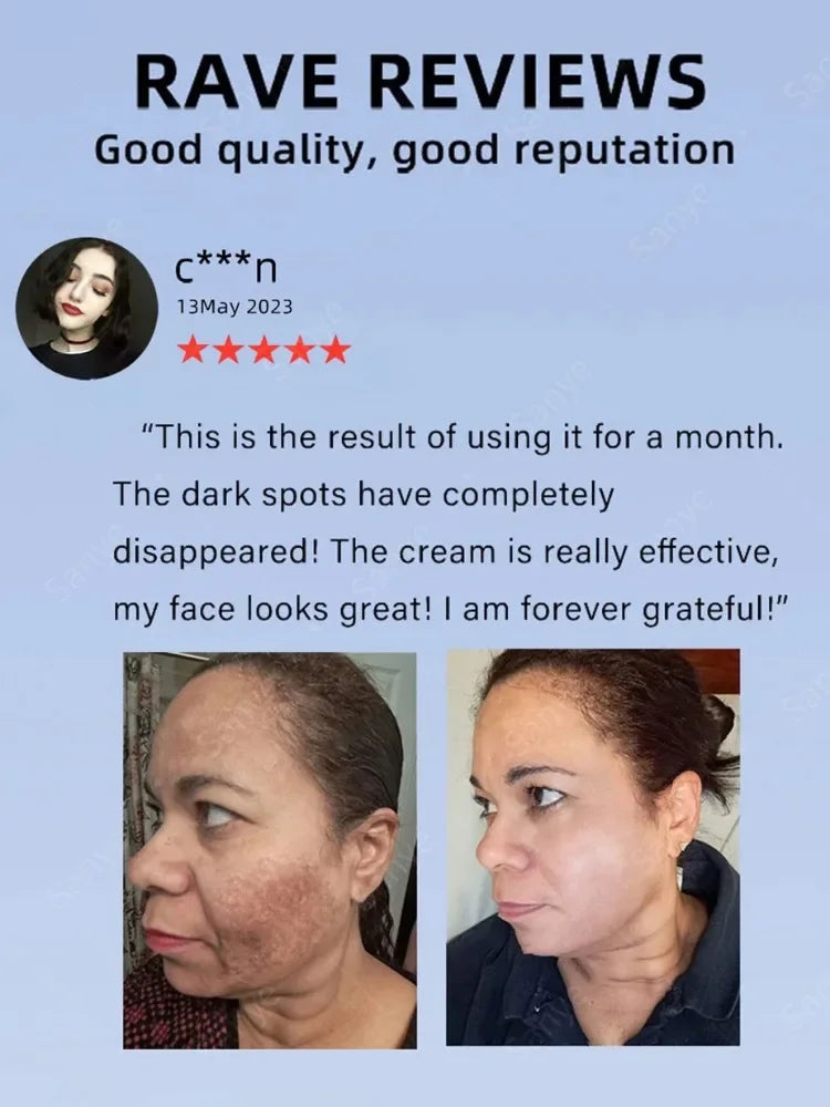 Face Chloasma Removal Cream For Women Remove Melasma Brighten Cream Facial Fade Dull Brightening Cream Dark Skin Lightening Care